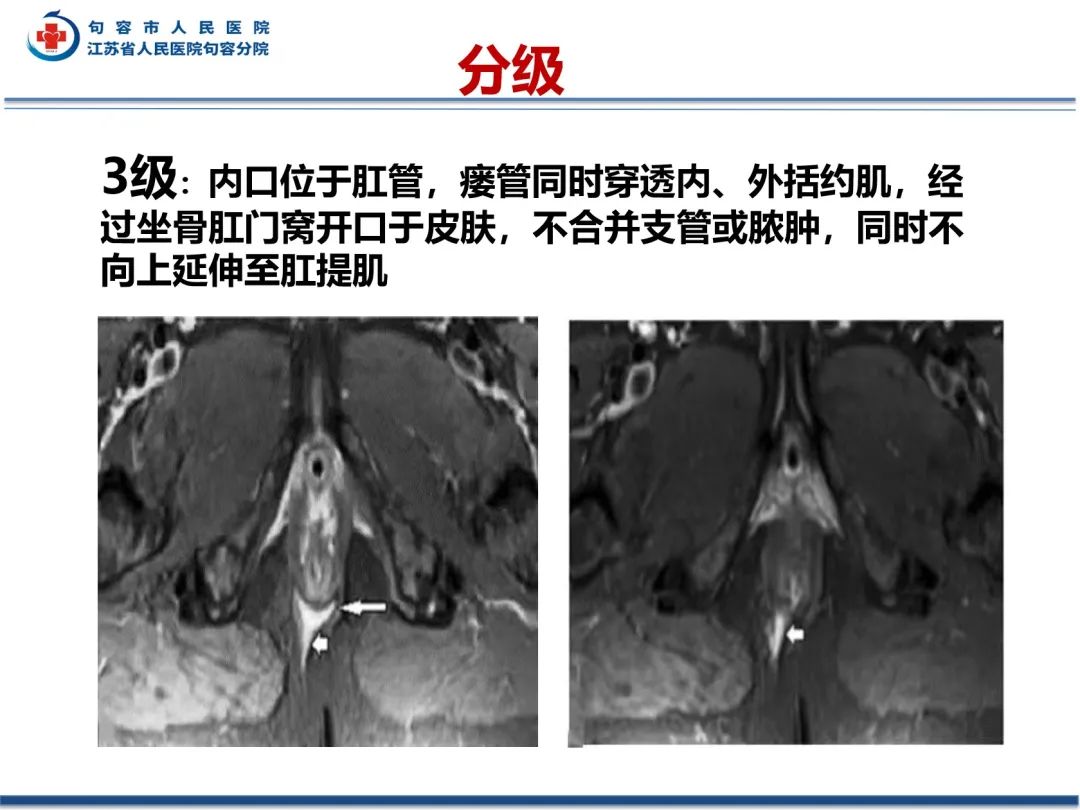 影像PPT - 【PPT】肛瘘-32