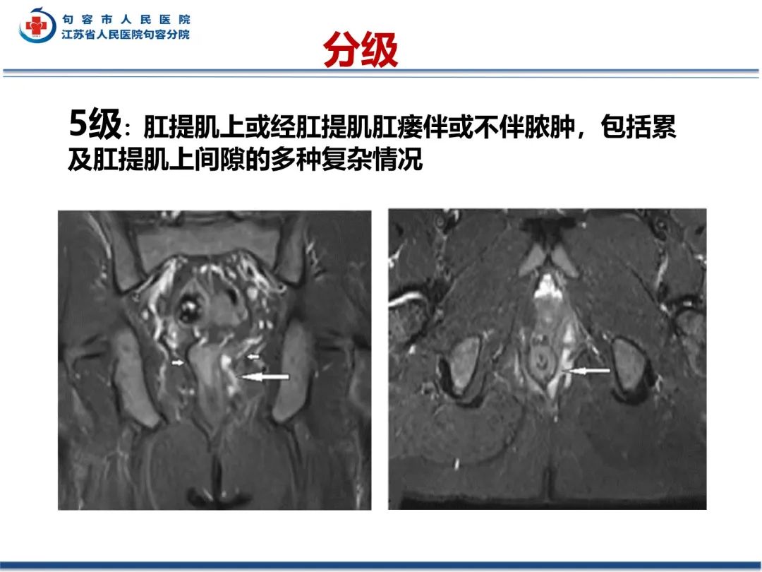 影像PPT - 【PPT】肛瘘-34