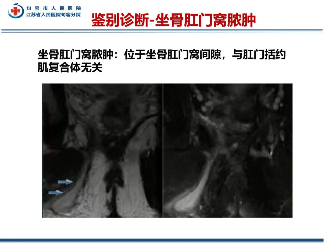 影像PPT - 【PPT】肛瘘-38