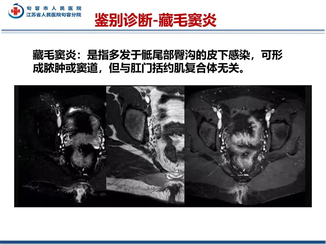 影像PPT - 【PPT】肛瘘-39