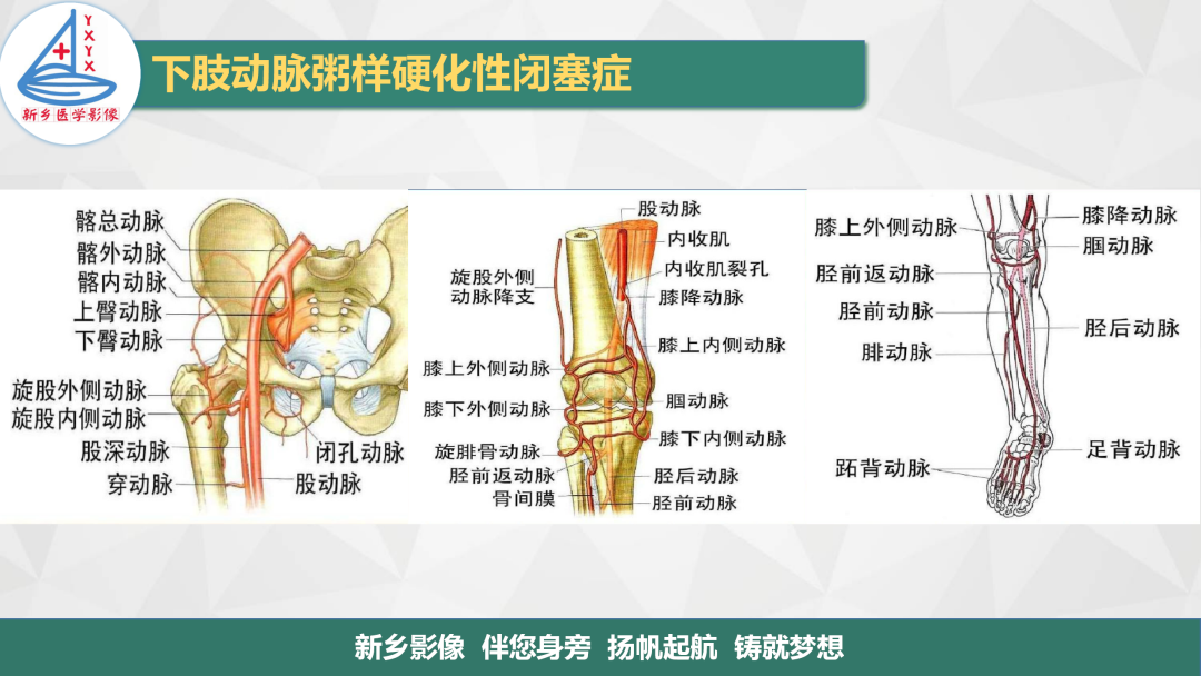 影像PPT - 【PPT】医学影像诊断学教材解读—下肢动脉粥样硬化性闭塞症-3