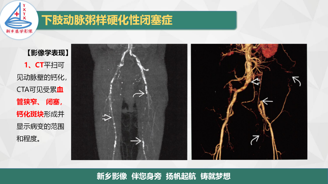 影像PPT - 【PPT】医学影像诊断学教材解读—下肢动脉粥样硬化性闭塞症-4
