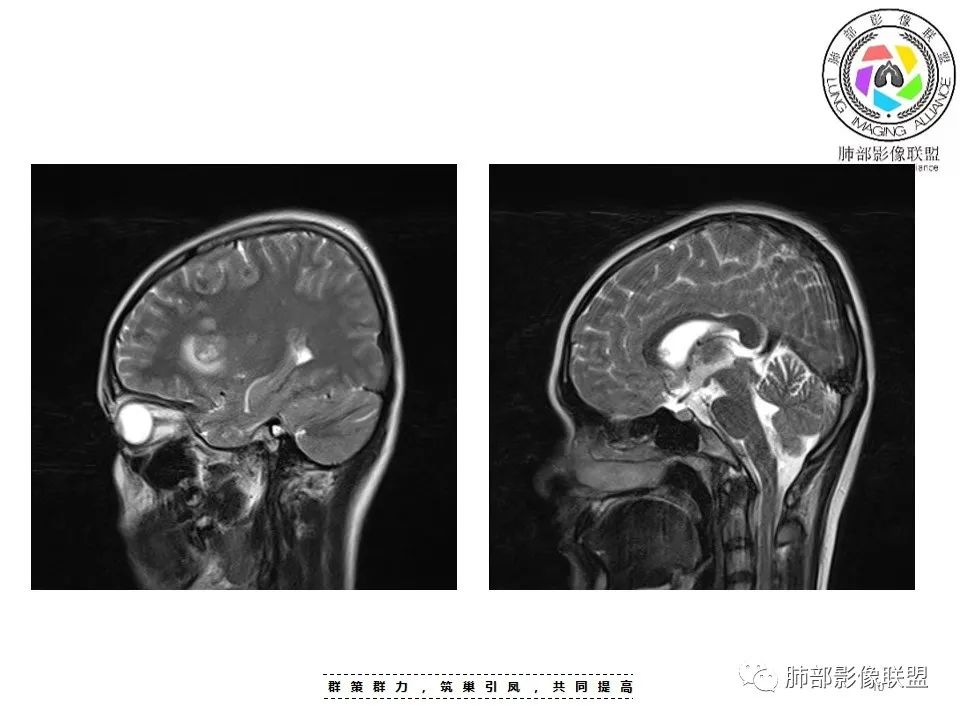 影像PPT - 【病例】15岁少女,肺脑同时病变,结果很意外-27 影像PPT - 【病例】15岁少女,肺脑同时病变,结果很意外-27