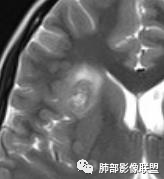影像PPT - 【病例】15岁少女,肺脑同时病变,结果很意外-29 影像PPT - 【病例】15岁少女,肺脑同时病变,结果很意外-29
