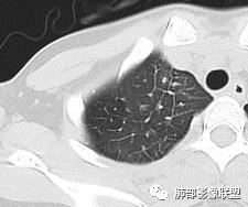 影像PPT - 【病例】15岁少女,肺脑同时病变,结果很意外-39 影像PPT - 【病例】15岁少女,肺脑同时病变,结果很意外-39