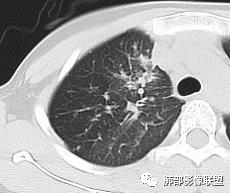 影像PPT - 【病例】15岁少女,肺脑同时病变,结果很意外-42 影像PPT - 【病例】15岁少女,肺脑同时病变,结果很意外-42