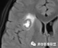影像PPT - 【病例】15岁少女,肺脑同时病变,结果很意外-45 影像PPT - 【病例】15岁少女,肺脑同时病变,结果很意外-45