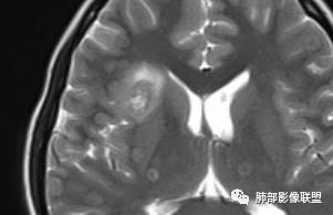 影像PPT - 【病例】15岁少女,肺脑同时病变,结果很意外-46 影像PPT - 【病例】15岁少女,肺脑同时病变,结果很意外-46