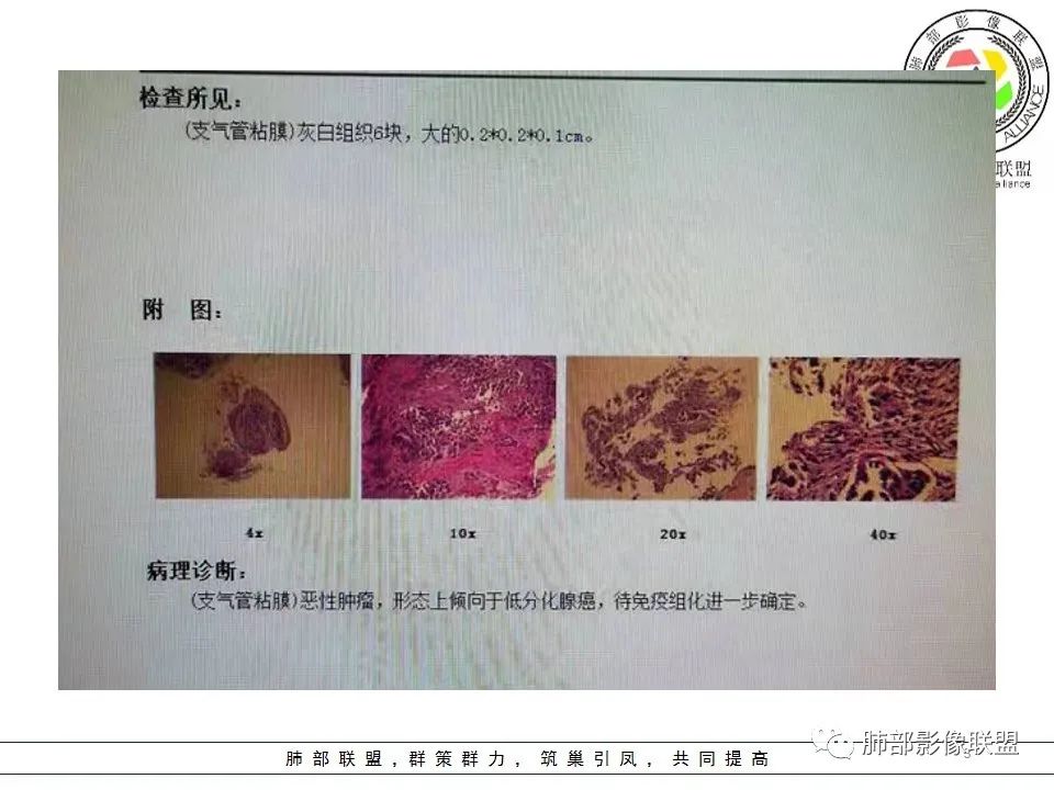 影像PPT - 【病例】15岁少女,肺脑同时病变,结果很意外-50 影像PPT - 【病例】15岁少女,肺脑同时病变,结果很意外-50