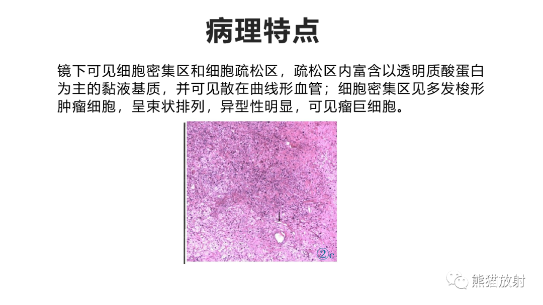 影像PPT - 【病例】软组织黏液纤维肉瘤 VS 多形性未分化肉瘤-22