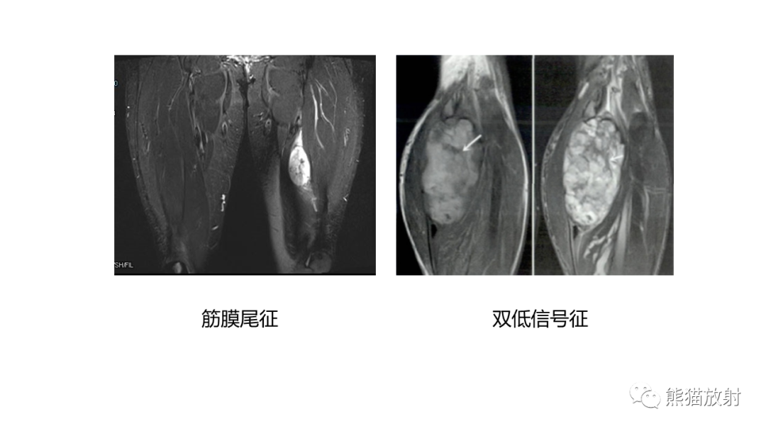 影像PPT - 【病例】软组织黏液纤维肉瘤 VS 多形性未分化肉瘤-26