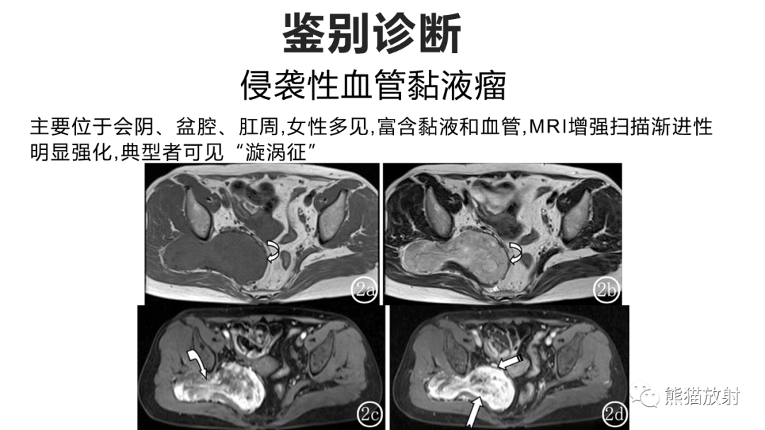影像PPT - 【病例】软组织黏液纤维肉瘤 VS 多形性未分化肉瘤-27