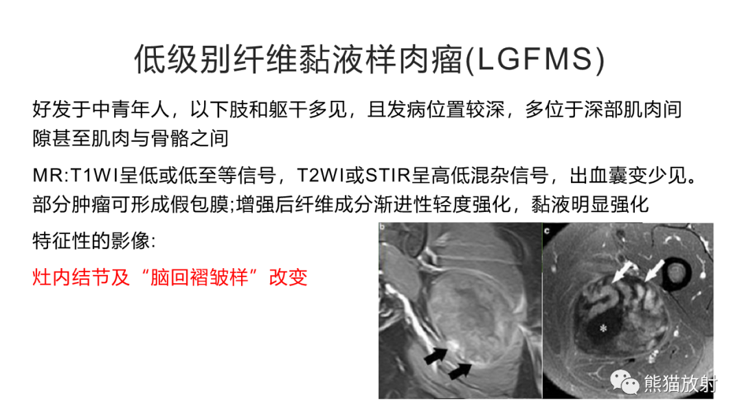 影像PPT - 【病例】软组织黏液纤维肉瘤 VS 多形性未分化肉瘤-28
