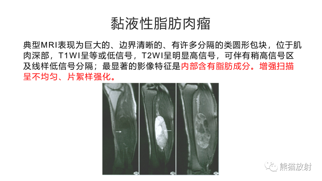 影像PPT - 【病例】软组织黏液纤维肉瘤 VS 多形性未分化肉瘤-29