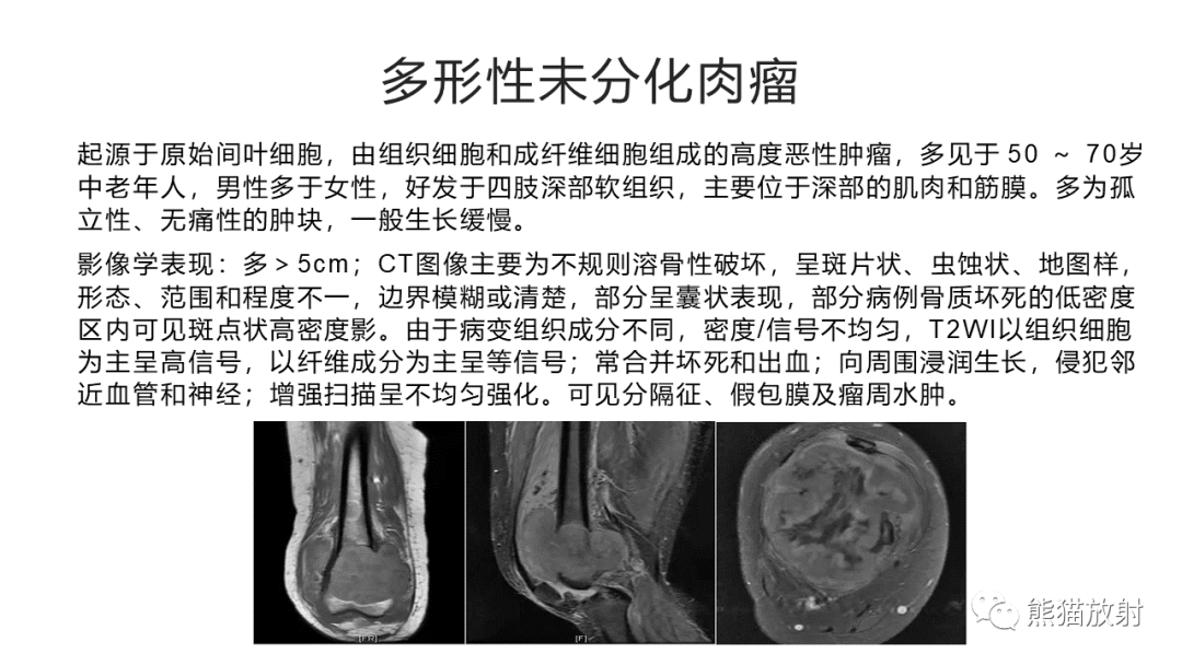 影像PPT - 【病例】软组织黏液纤维肉瘤 VS 多形性未分化肉瘤-30