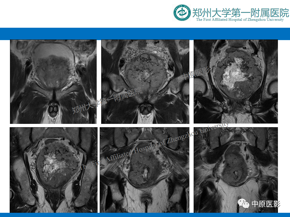 影像PPT - 【病例】前列腺胃肠道外间质瘤-6