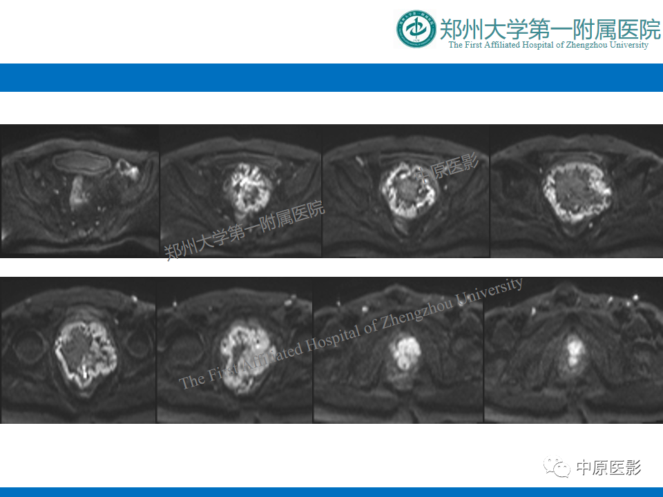 影像PPT - 【病例】前列腺胃肠道外间质瘤-7