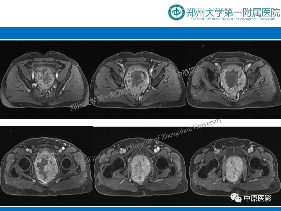 影像PPT - 【病例】前列腺胃肠道外间质瘤-9
