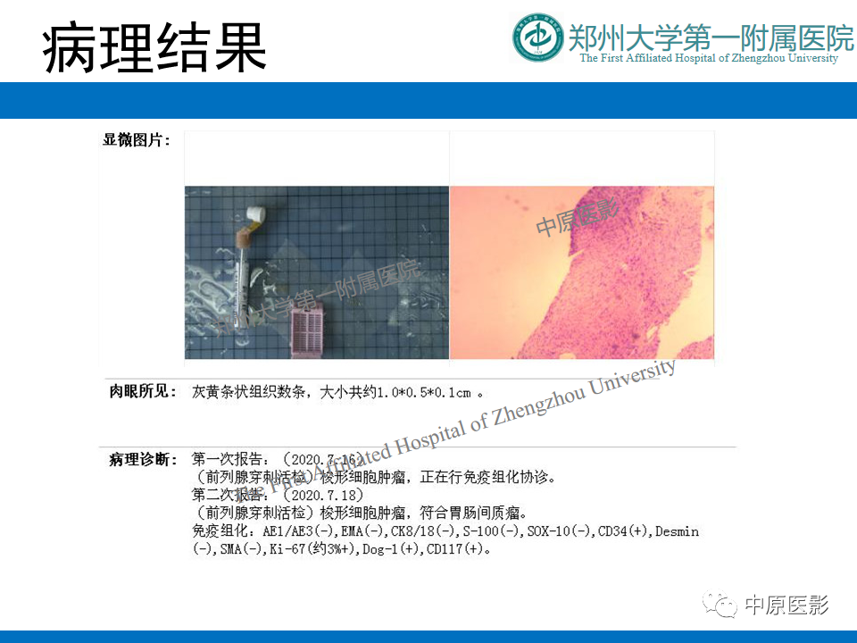 影像PPT - 【病例】前列腺胃肠道外间质瘤-13