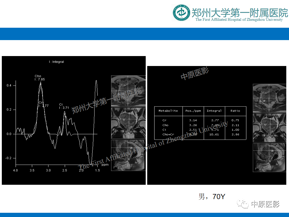 影像PPT - 【病例】前列腺胃肠道外间质瘤-23