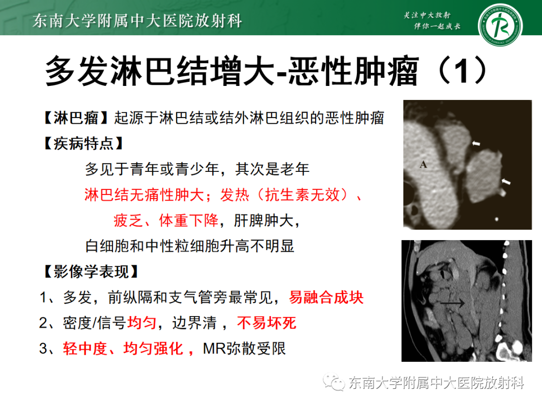 影像PPT - 【PPT】多发性淋巴结增大影像诊断思路-25 影像PPT - 【PPT】多发性淋巴结增大影像诊断思路-25