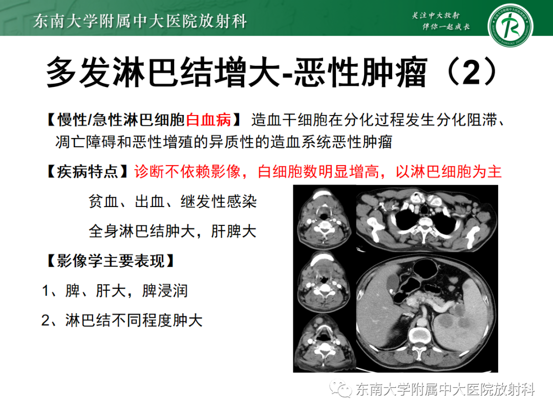影像PPT - 【PPT】多发性淋巴结增大影像诊断思路-26 影像PPT - 【PPT】多发性淋巴结增大影像诊断思路-26