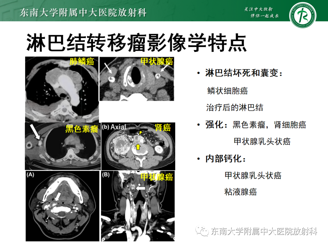 影像PPT - 【PPT】多发性淋巴结增大影像诊断思路-28 影像PPT - 【PPT】多发性淋巴结增大影像诊断思路-28