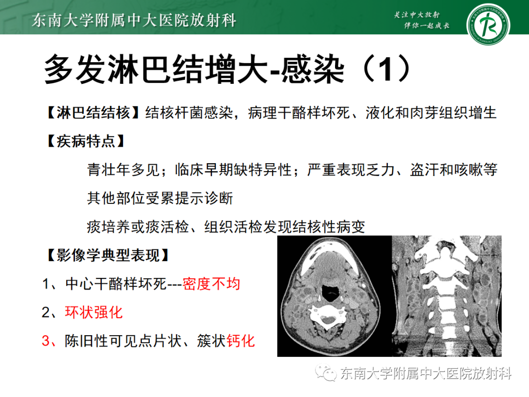 影像PPT - 【PPT】多发性淋巴结增大影像诊断思路-29 影像PPT - 【PPT】多发性淋巴结增大影像诊断思路-29