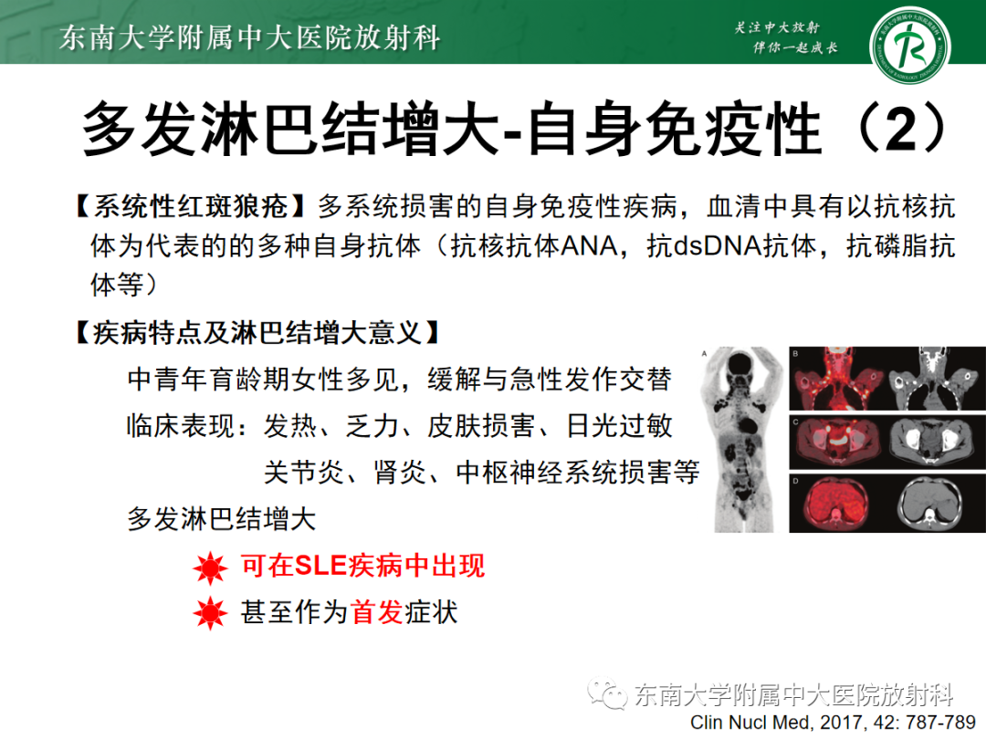 影像PPT - 【PPT】多发性淋巴结增大影像诊断思路-32 影像PPT - 【PPT】多发性淋巴结增大影像诊断思路-32