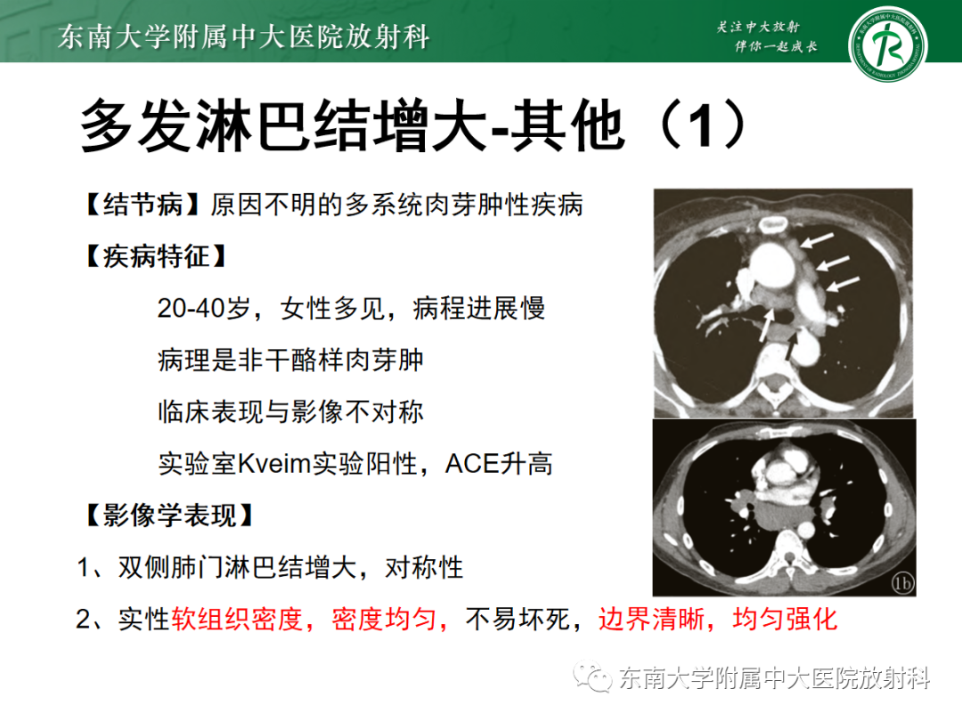 影像PPT - 【PPT】多发性淋巴结增大影像诊断思路-33 影像PPT - 【PPT】多发性淋巴结增大影像诊断思路-33