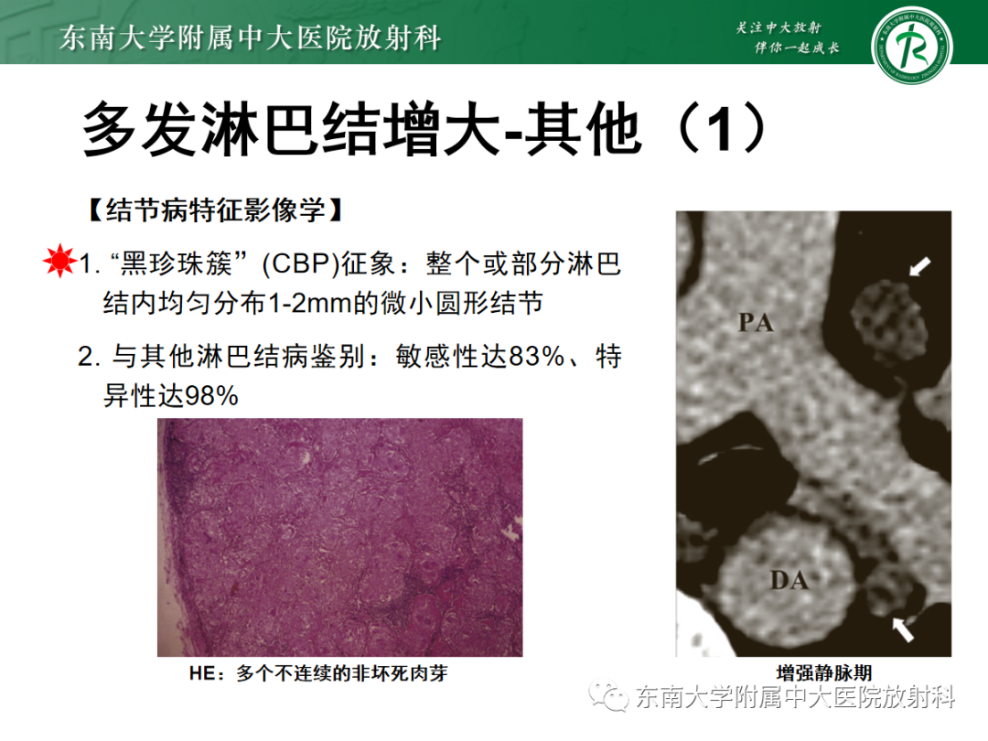 影像PPT - 【PPT】多发性淋巴结增大影像诊断思路-34 影像PPT - 【PPT】多发性淋巴结增大影像诊断思路-34