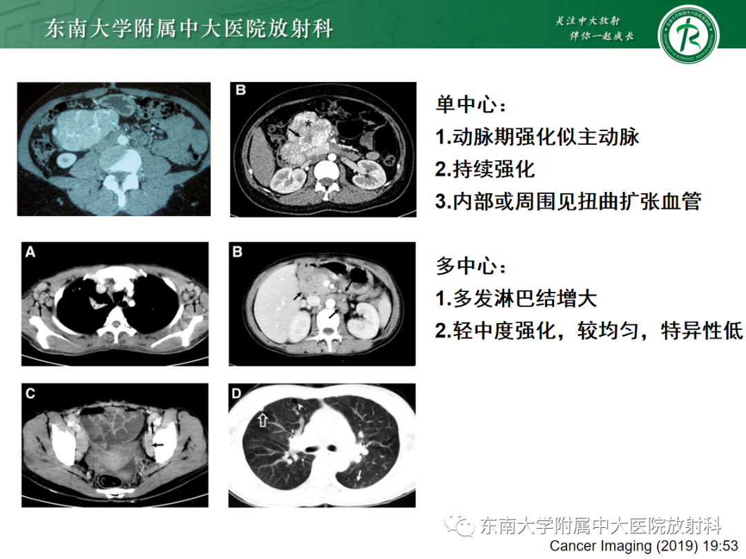 影像PPT - 【PPT】多发性淋巴结增大影像诊断思路-36 影像PPT - 【PPT】多发性淋巴结增大影像诊断思路-36