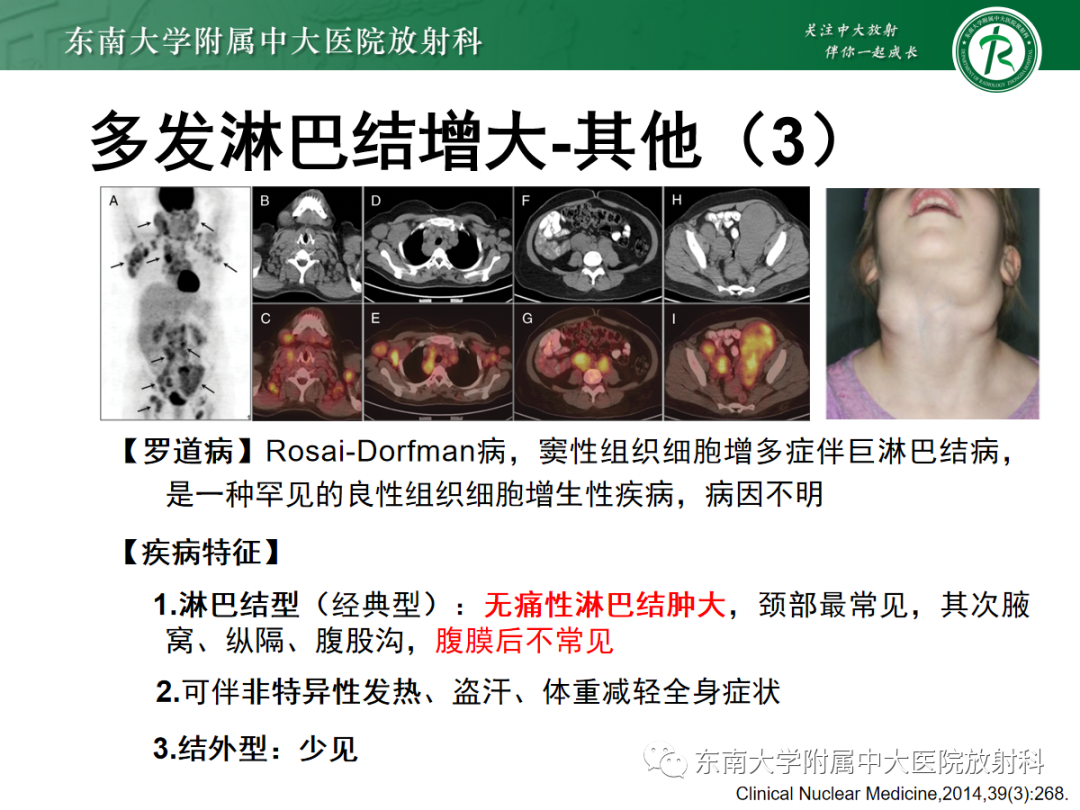 影像PPT - 【PPT】多发性淋巴结增大影像诊断思路-37 影像PPT - 【PPT】多发性淋巴结增大影像诊断思路-37