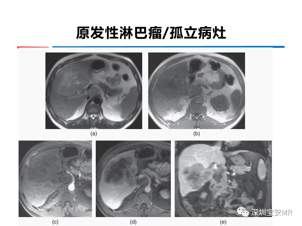 影像PPT - 【PPT】肝脏少见肿瘤-6