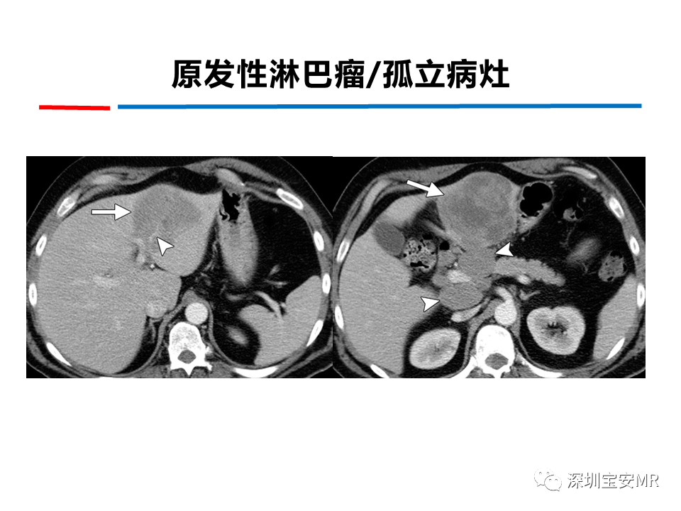 影像PPT - 【PPT】肝脏少见肿瘤-7