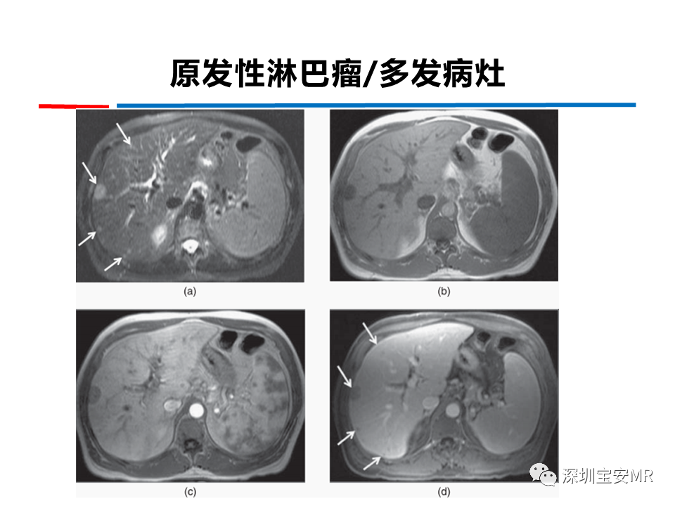 影像PPT - 【PPT】肝脏少见肿瘤-9
