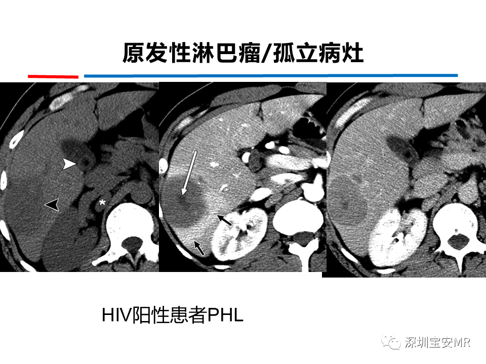 影像PPT - 【PPT】肝脏少见肿瘤-8