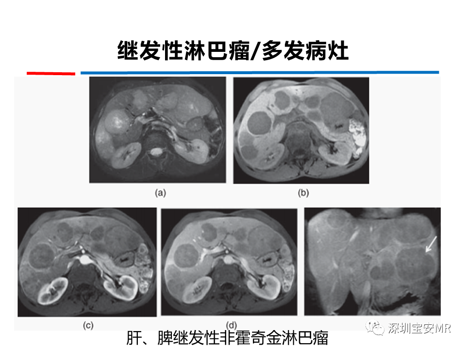 影像PPT - 【PPT】肝脏少见肿瘤-11
