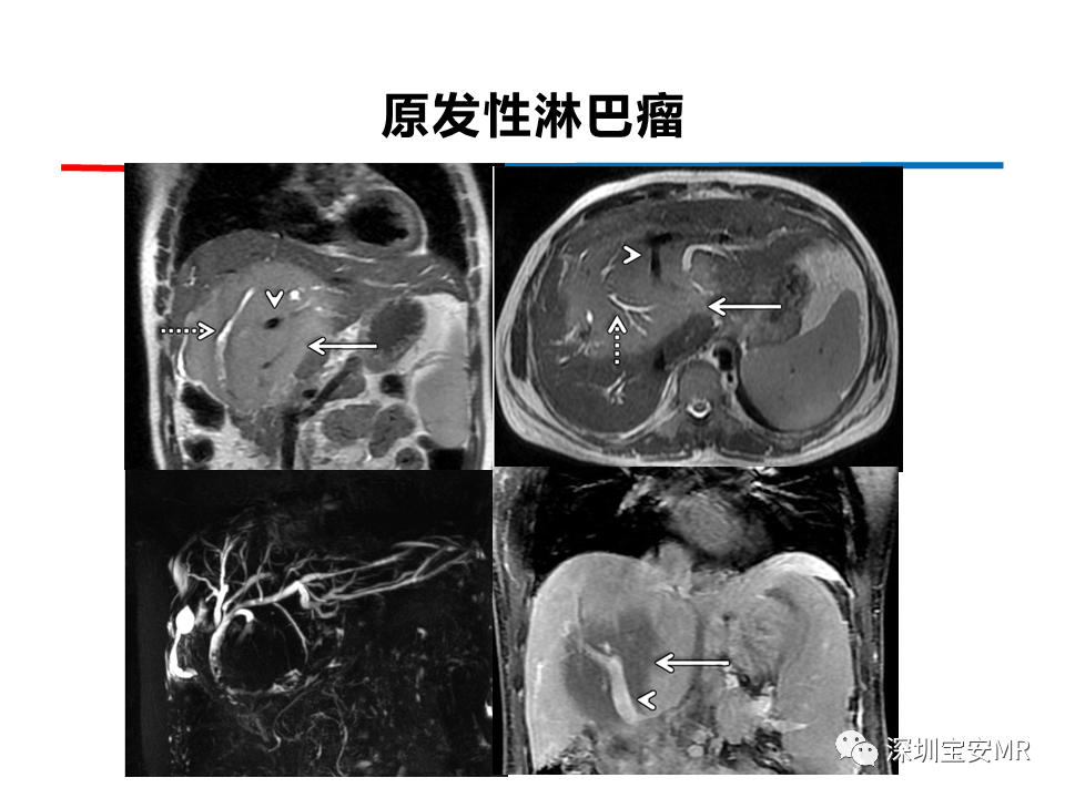 影像PPT - 【PPT】肝脏少见肿瘤-10