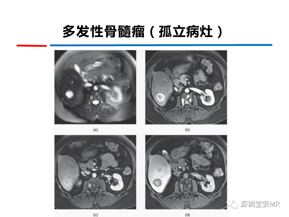 影像PPT - 【PPT】肝脏少见肿瘤-15