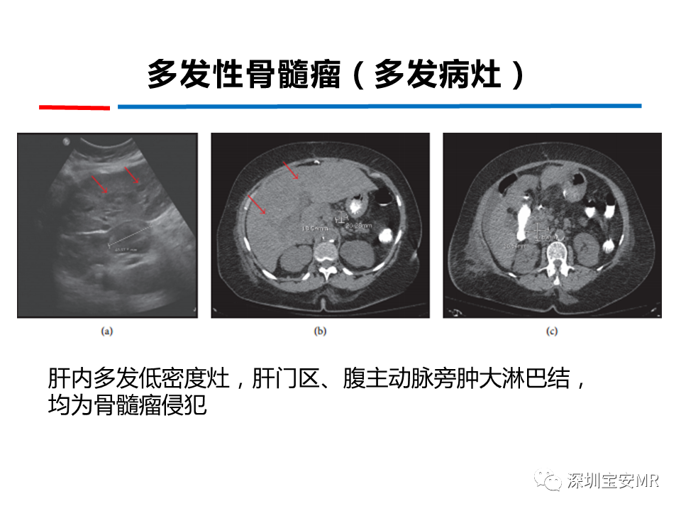 影像PPT - 【PPT】肝脏少见肿瘤-16
