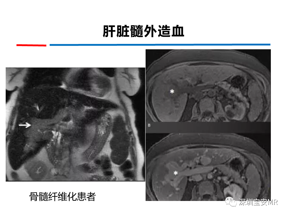影像PPT - 【PPT】肝脏少见肿瘤-20