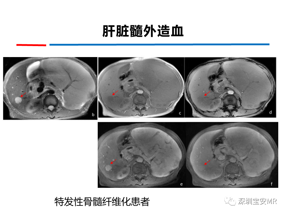 影像PPT - 【PPT】肝脏少见肿瘤-21