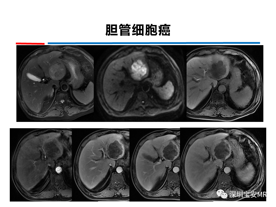 影像PPT - 【PPT】肝脏少见肿瘤-24