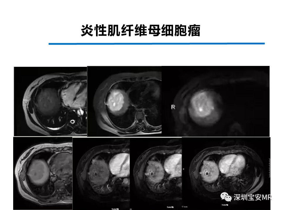 影像PPT - 【PPT】肝脏少见肿瘤-26