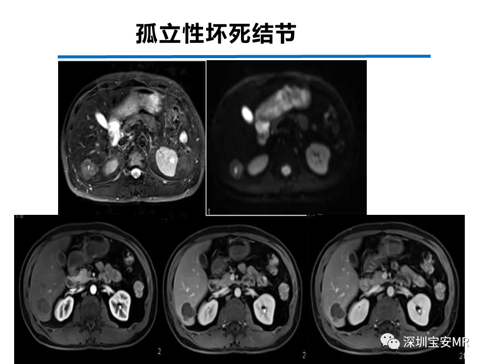 影像PPT - 【PPT】肝脏少见肿瘤-28