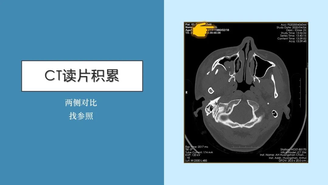 影像PPT - 【PPT】颅骨的孔裂、缝及骨折线CT读片-14