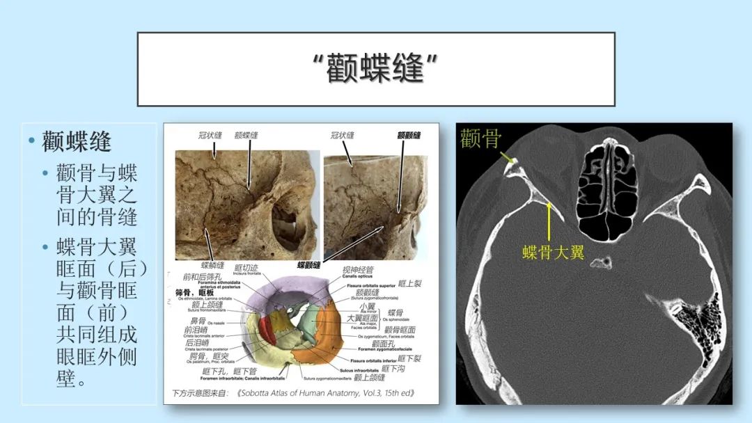 影像PPT - 【PPT】颅骨的孔裂、缝及骨折线CT读片-15
