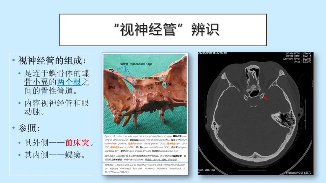 影像PPT - 【PPT】颅骨的孔裂、缝及骨折线CT读片-16