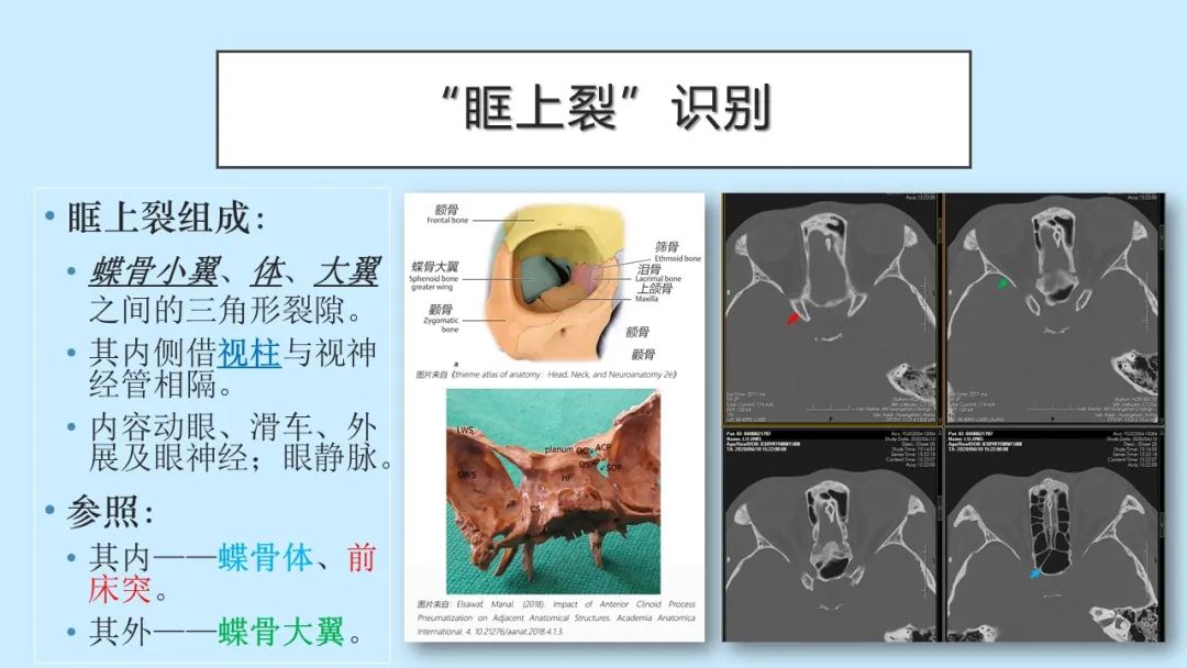 影像PPT - 【PPT】颅骨的孔裂、缝及骨折线CT读片-17